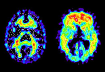 Cells Alzheimer Neurons Brain Nature 3