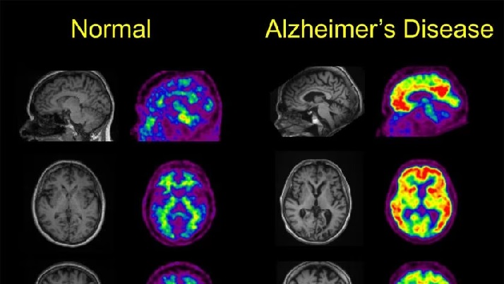 Cells Alzheimer Neurons Brain Nature 6